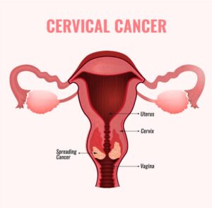 Cervical Cancer