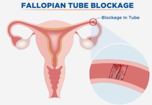 Fallopian Tube Blockage