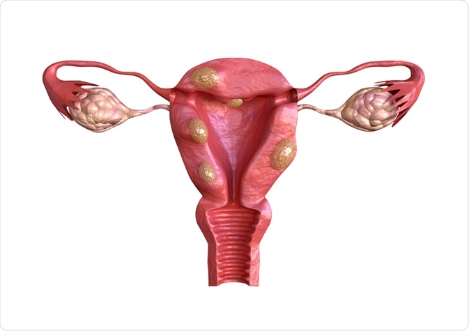 best Gynecologic Oncologist in Delhi explains Fibroid Tumors