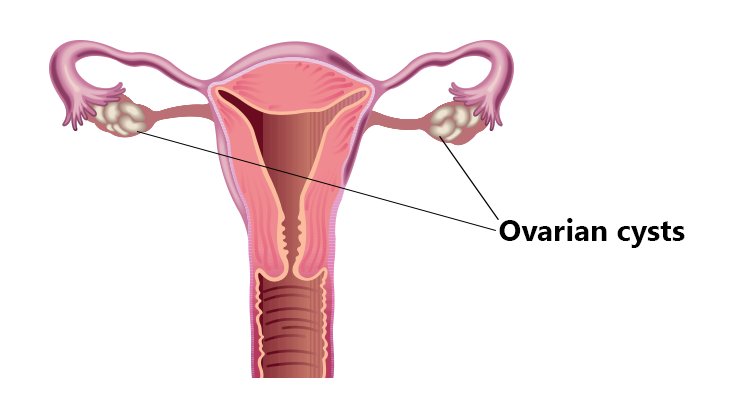 ovarian-cysts