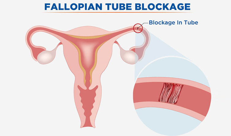 fallopialtubalblockage