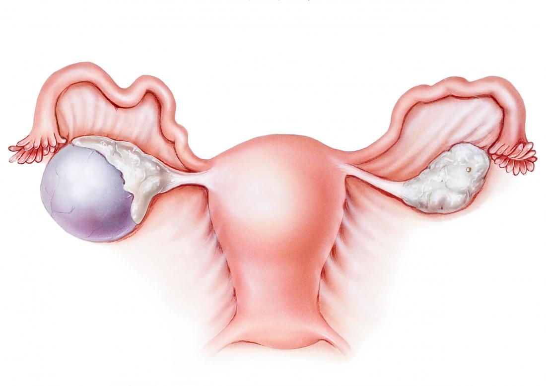 ovarian-cyst