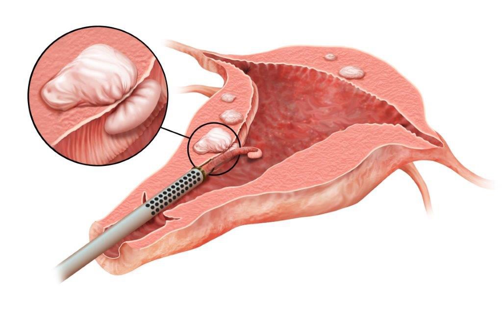 Best Laparoscopic Surgeon in Delhi - Myomectomy