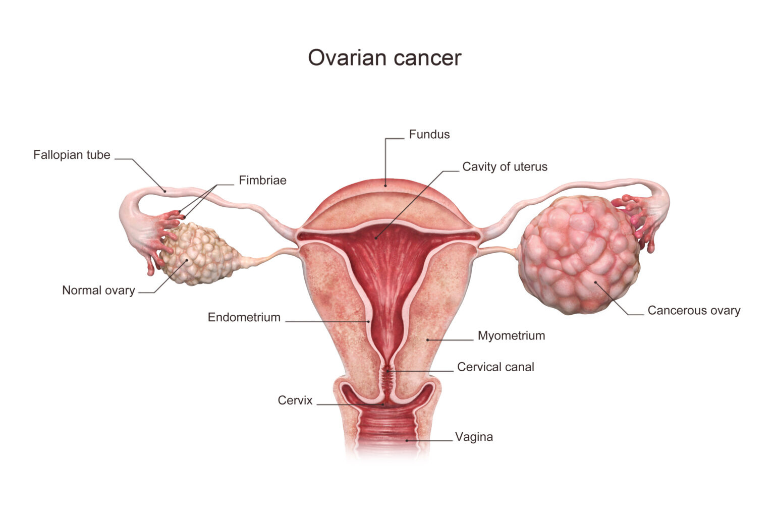 Best Gynecologic Oncologist in India - Ovarian Cancer