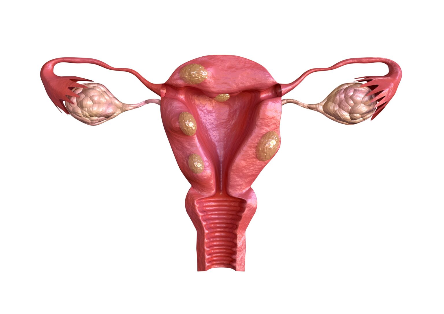 Best doctor for Uterine Fibroids in Delhi - Dr. Usha M Kumar