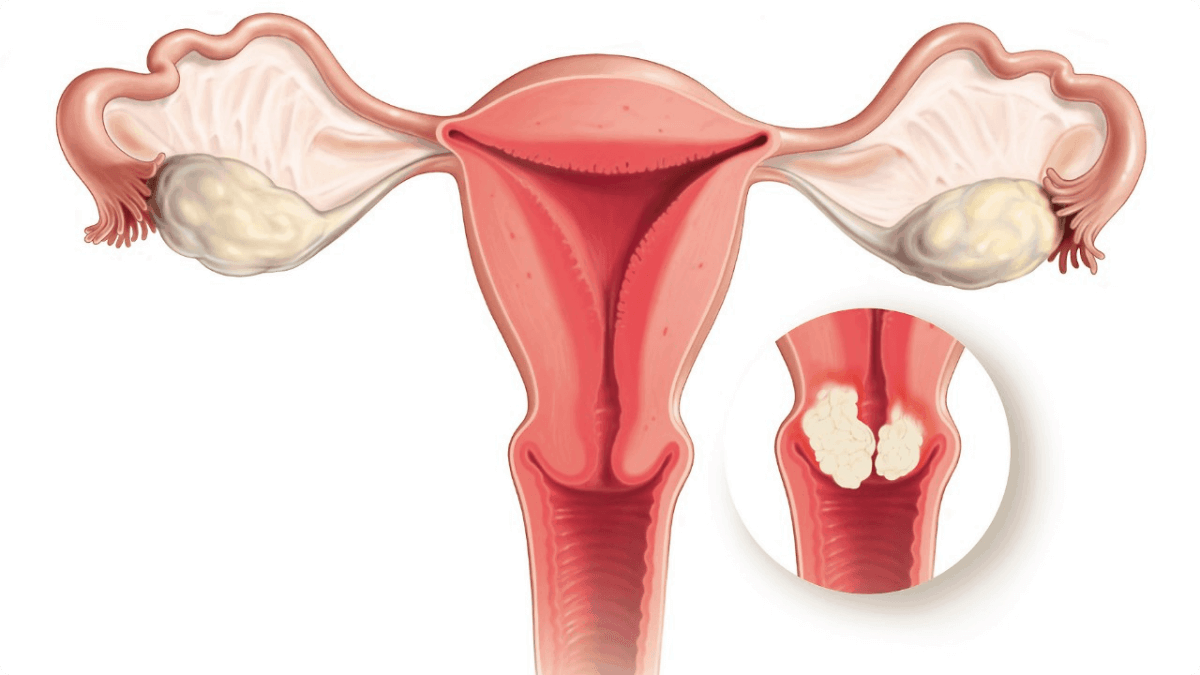 Cervical-Cancer -Dr. Usha M Kumar