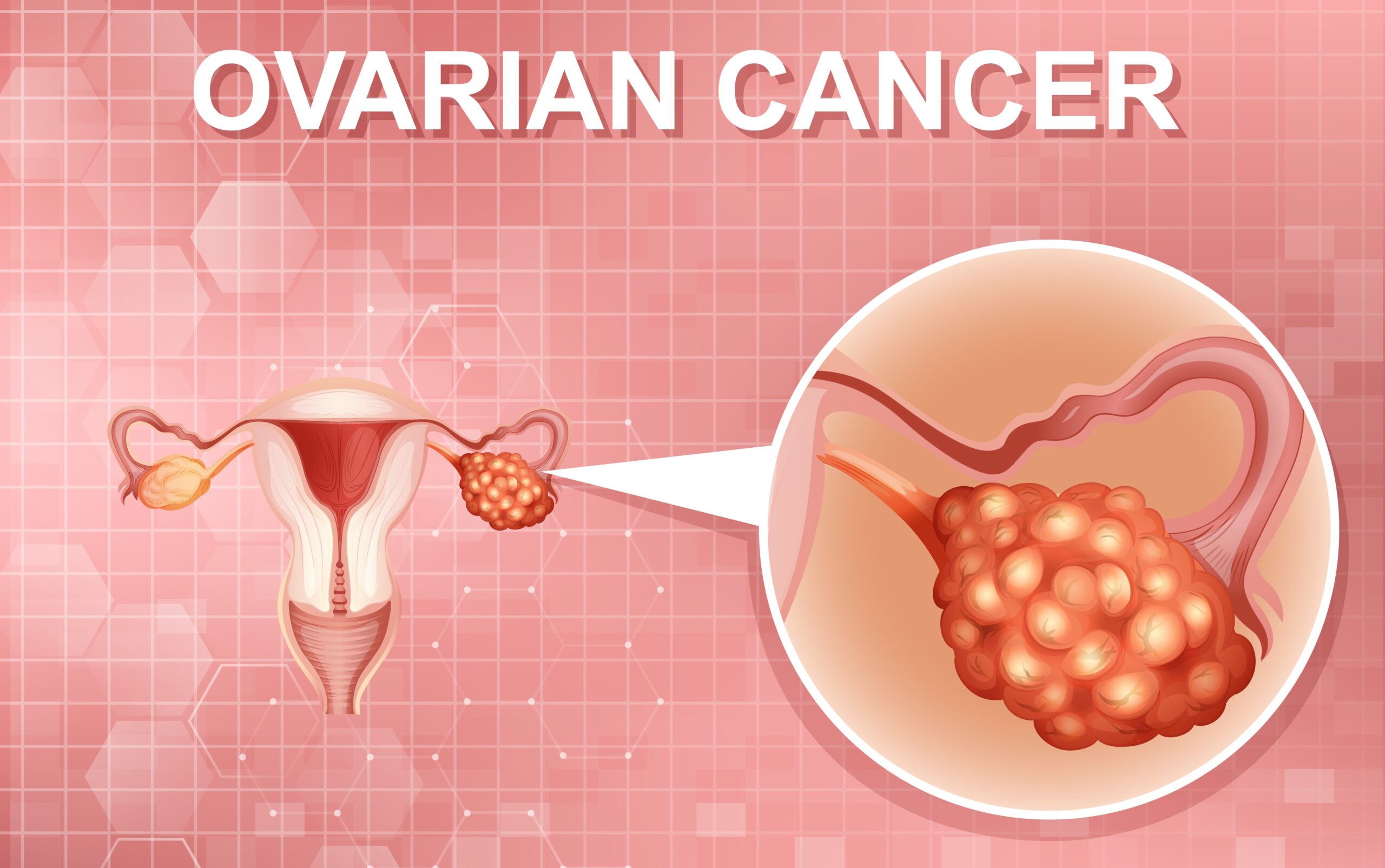 Ovarian Cancer Prevention - Dr. Usha M Kumar