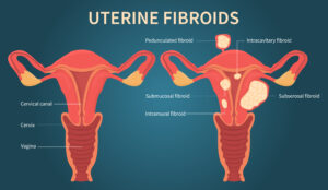 Best Doctor For Uterine Fibroids in Delhi - Dr. Usha-M-Kumar