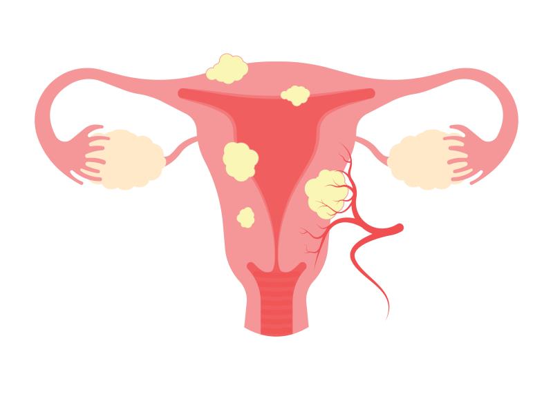 Best Uterine Fibroids Doctor in Delhi - Dr. Usha M Kumar