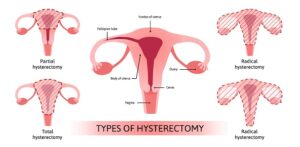 Hysterectomy - Dr. Usha M Kumar