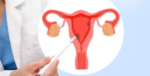 Uterine Cancer - Endometrial Cancer - Dr. Usha M Kumar