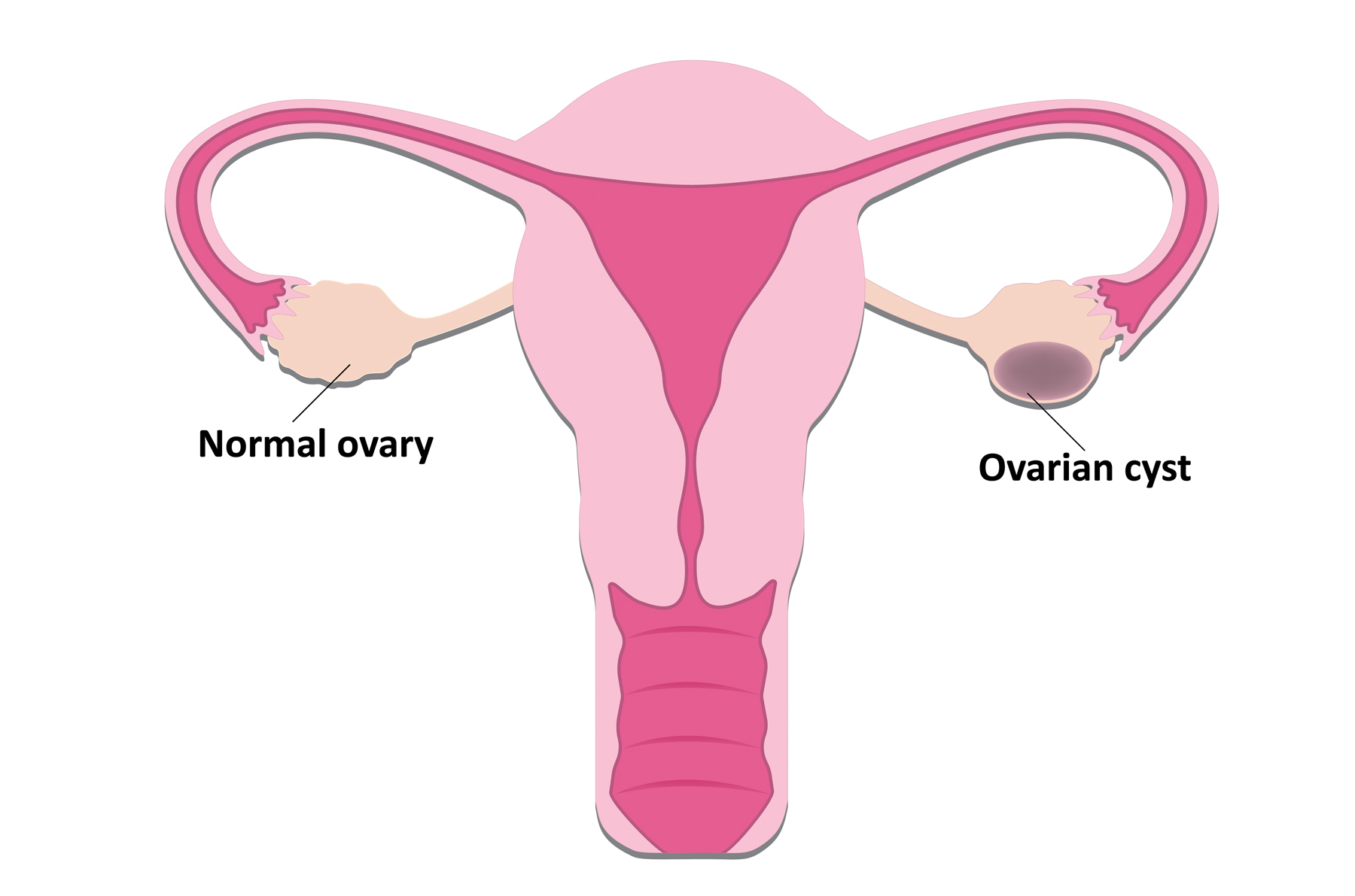 Best Doctor for Ovarian Cysts in Delhi - Dr. Usha M Kumar