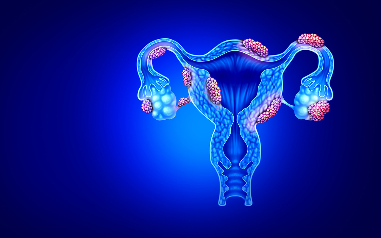 Understanding Endometriosis - Expert Insights from the Best Gynecologist in Delhi