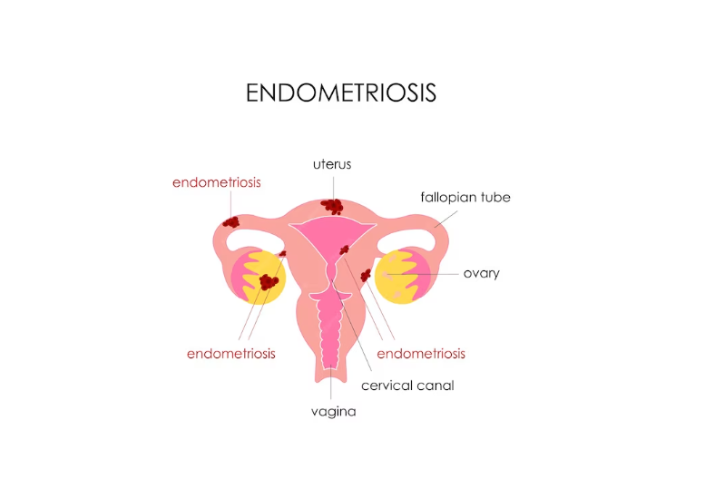 Best Doctor for Endometriosis - Raising Endometriosis Awareness