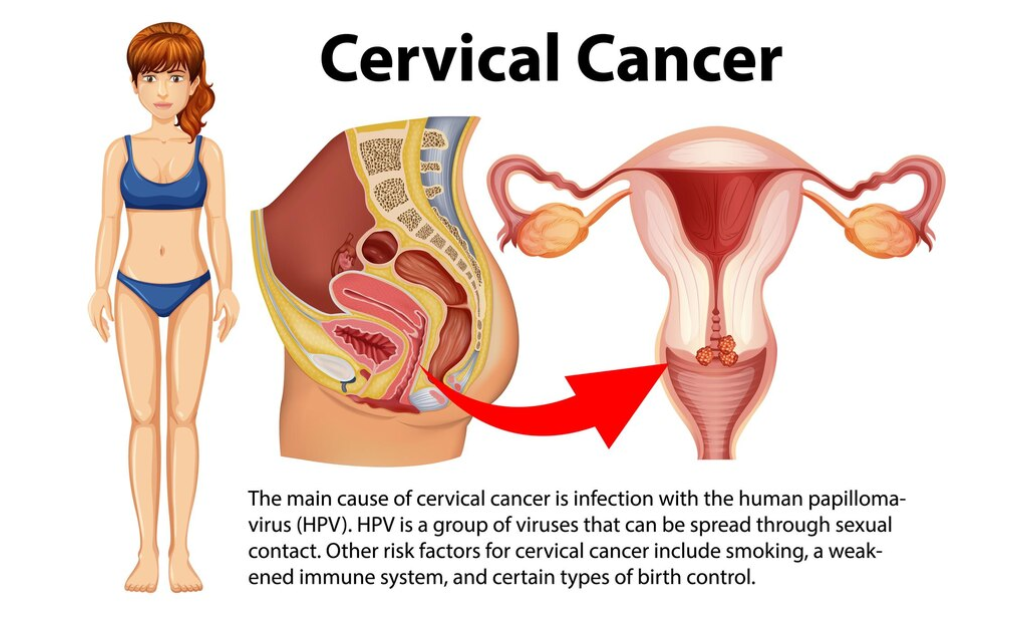 Signs Of Cervical Cancer in Females - Dr. Usha M Kumar