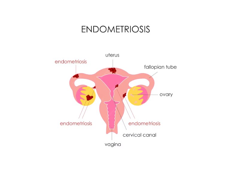 Endometriosis Symptoms, Diagnosis, and Treatment Options