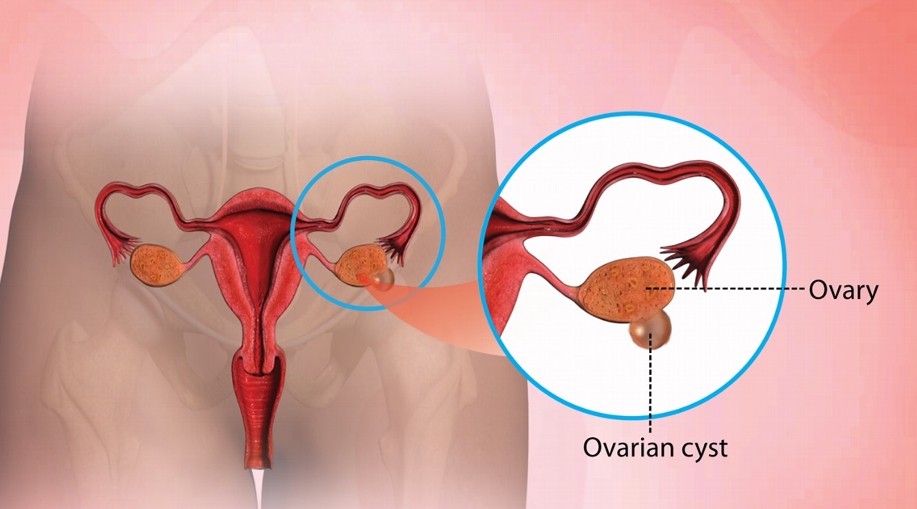 Ovarian Cysts Symptoms, Causes, and Treatment - Dr Usha Kumar