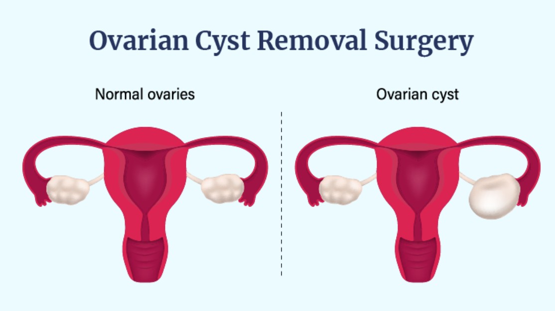 How Robotic Surgery Helps in Treating Ovarian Cysts Safely