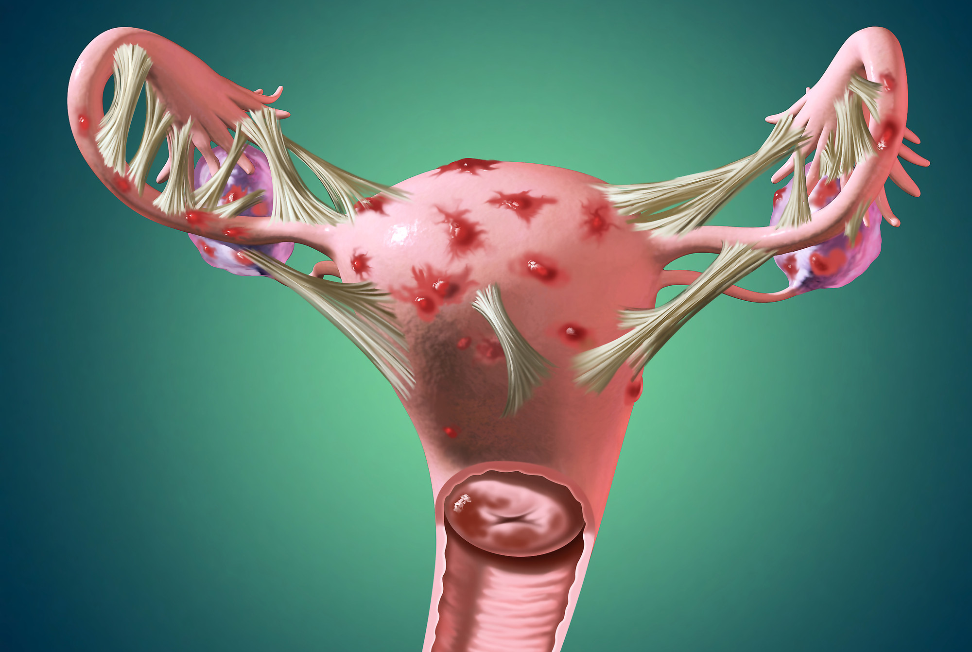 Endometriosis Ureterolysis Surgery - Robotic Gynecologist in Delhi