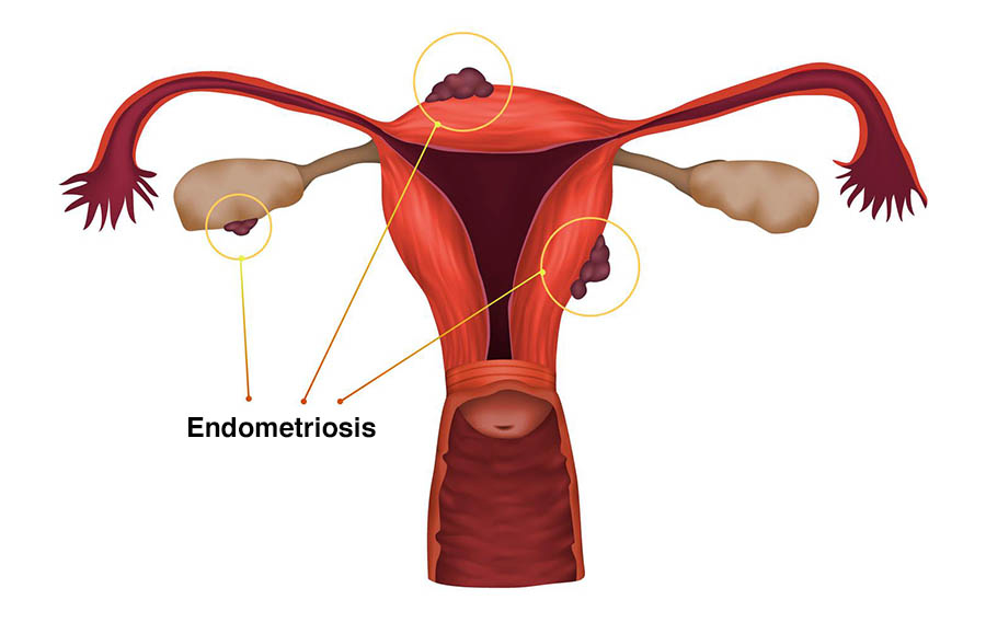 Endometriosis Explained - The Hidden Cause of Period Pain