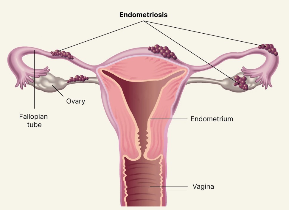 Best Endometriosis Specialist in Delhi - About Endometriosis